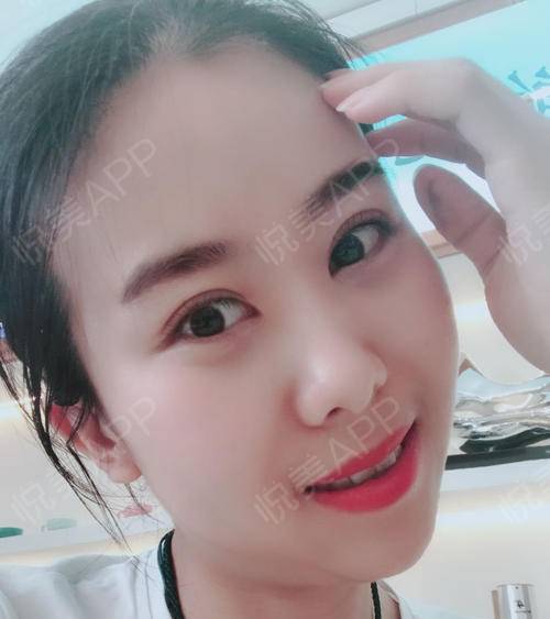 眼睛一點點恢復，越來越好看 眼部多項手術的蛻變之旅